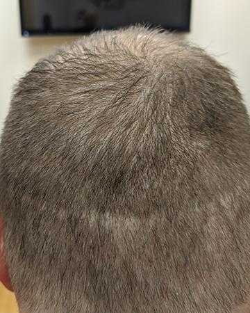  before after gallery mens gallery scalp micropigmentation 02 SMP before