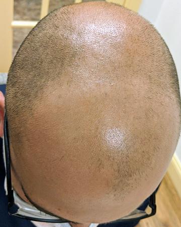  before after gallery mens gallery scalp micropigmentation 03 SMP before