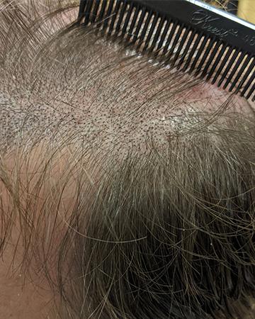  solutions mens gallery scalp micropigmentation 01 SMP after