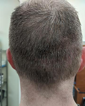  solutions mens gallery scalp micropigmentation 02 SMP after