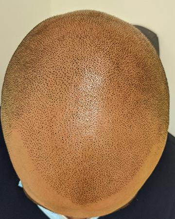  solutions mens gallery scalp micropigmentation 03 SMP after